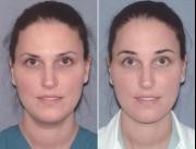 Brow Lift Surgery Before and After Maryland