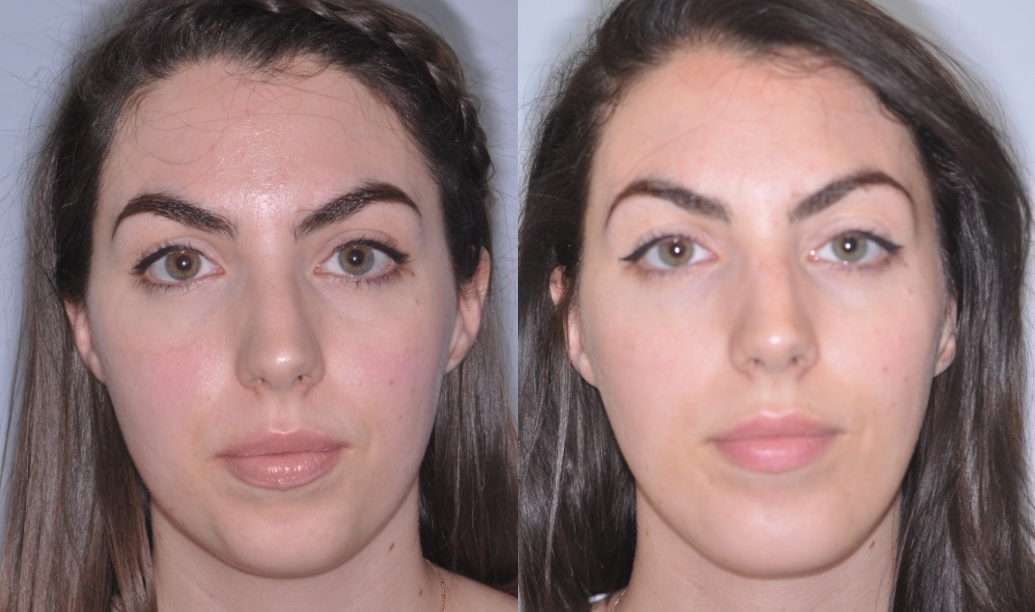Chin Implant Surgery Before and After Maryland
