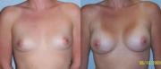 Breast Augmentation Ijamsville, MD