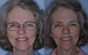 Dental Surgery Before and After Maryland