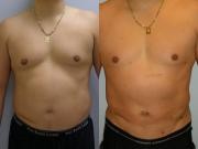 Liposuction before and After images Maryland