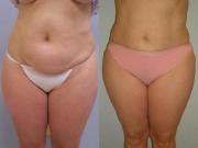Tummy tuck Maryland before and after photos
